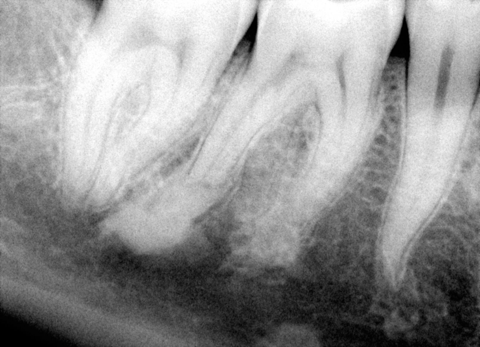 1 Pre op 30 Modern Endodontic Care