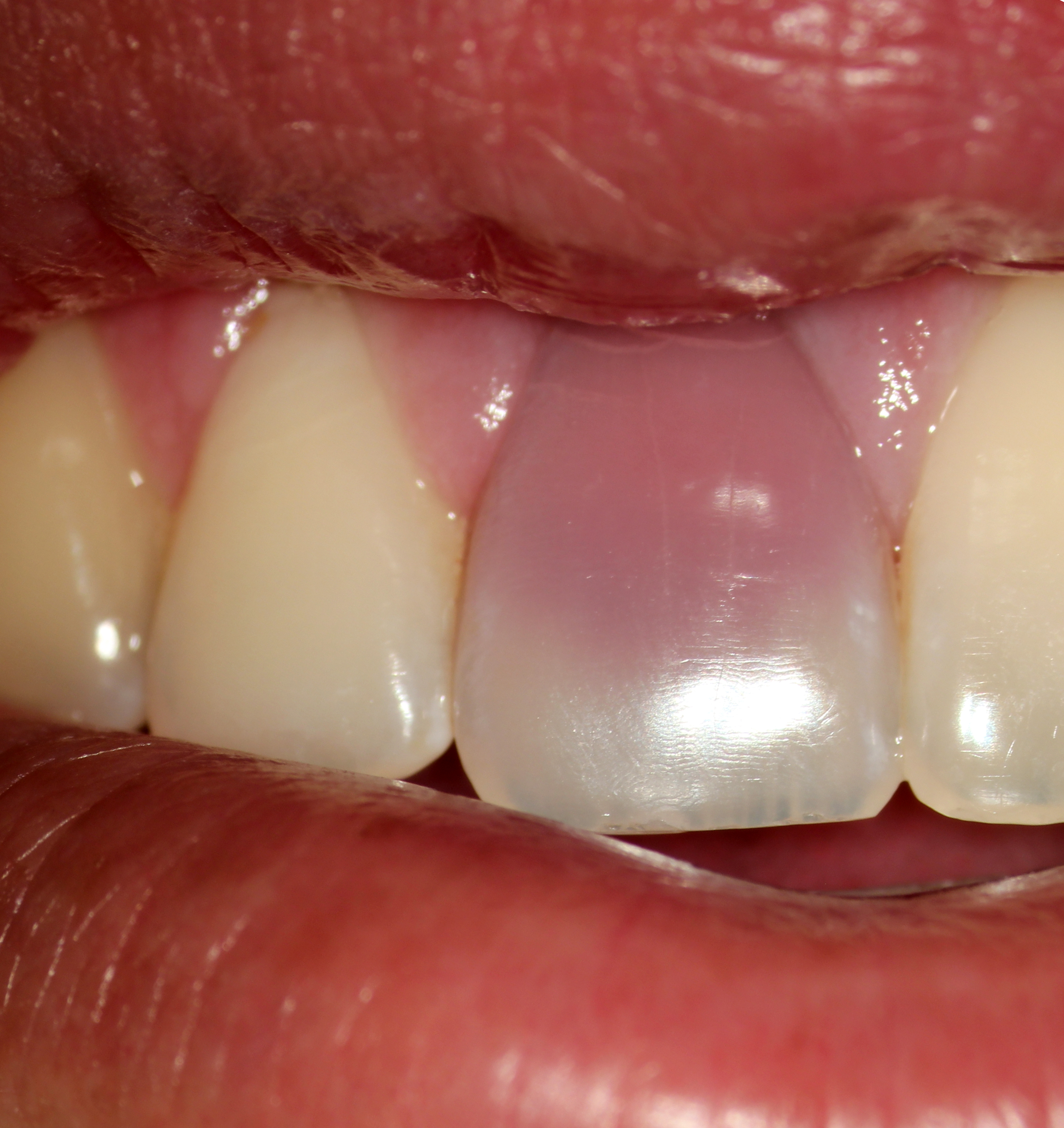 1 Pre op Photo Modern Endodontic Care