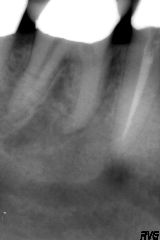 1 Pre op Modern Endodontic Care